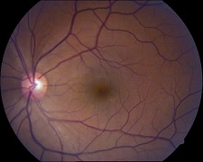 Retinopatía diabética