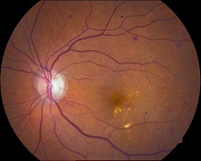 Retinopatía diabética