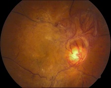 Retinopatía diabética